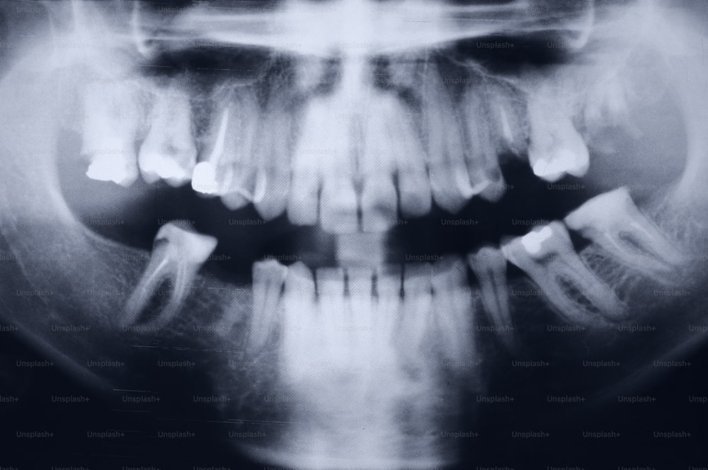 Röntgen medizinischer Zahnarztscan. Dies ist eine Aufnahme des Originalscans von Mund und Zähnen.