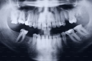 Gammagrafía médica del dentista. Esta es una toma del escaneo original de la boca y los dientes.