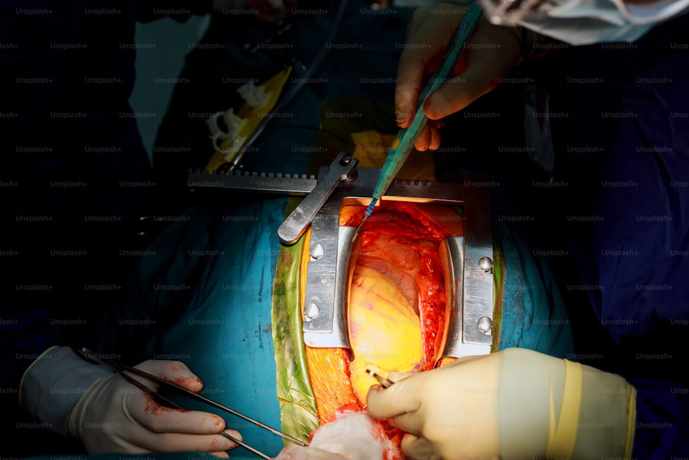 Doctor holding surgical instruments during medical procedure at clinic Teamwork surgeons during open-heart surgery