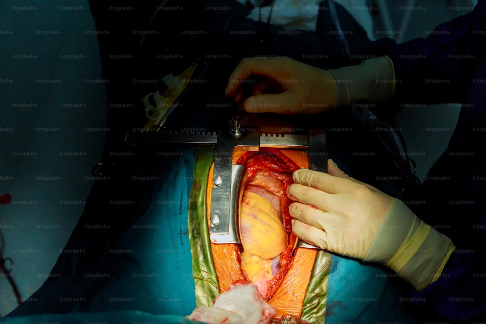 Surgeon pinches the tube and blocks the blood circulation during the open heart surgery