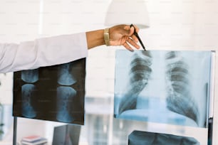 Afroamerikanischer Gesundheitsarbeiter mit Röntgen. Beschnittenes Bild der Hand eines männlichen afrikanischen Arztes, das auf das radiologische Bild der Patientenbrust zeigt.