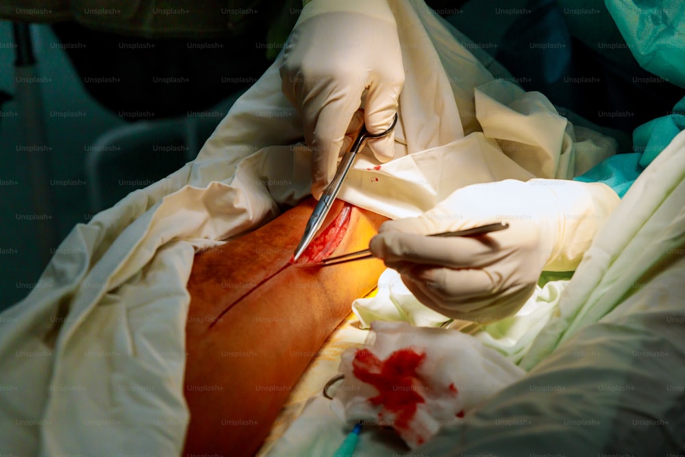 수술로 인한 피 묻은 흉터가있는 인간의 다리를 조금 더 깊게 절개 한 환자.