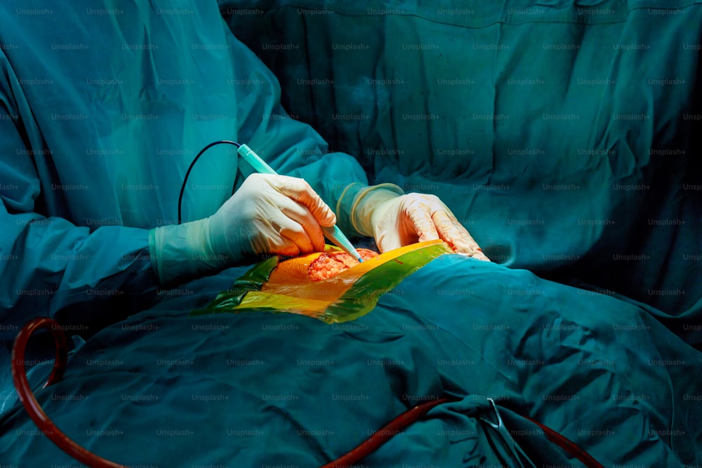 Cirujano y equipo de cirugía pulmonar realizan cirugía torácica en cáncer de pulmón