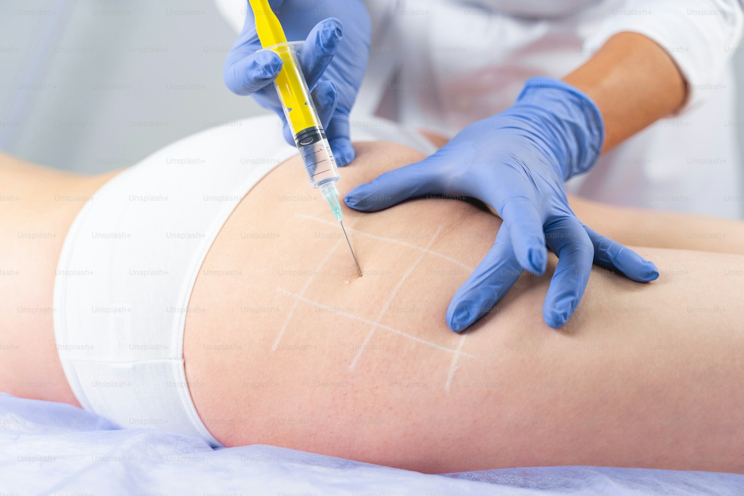 Intralipoterapia