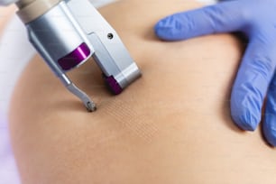 Foto recortada de paciente do sexo feminino sendo tratada para celulite por um dermatologista usando cosmetologia de hardware