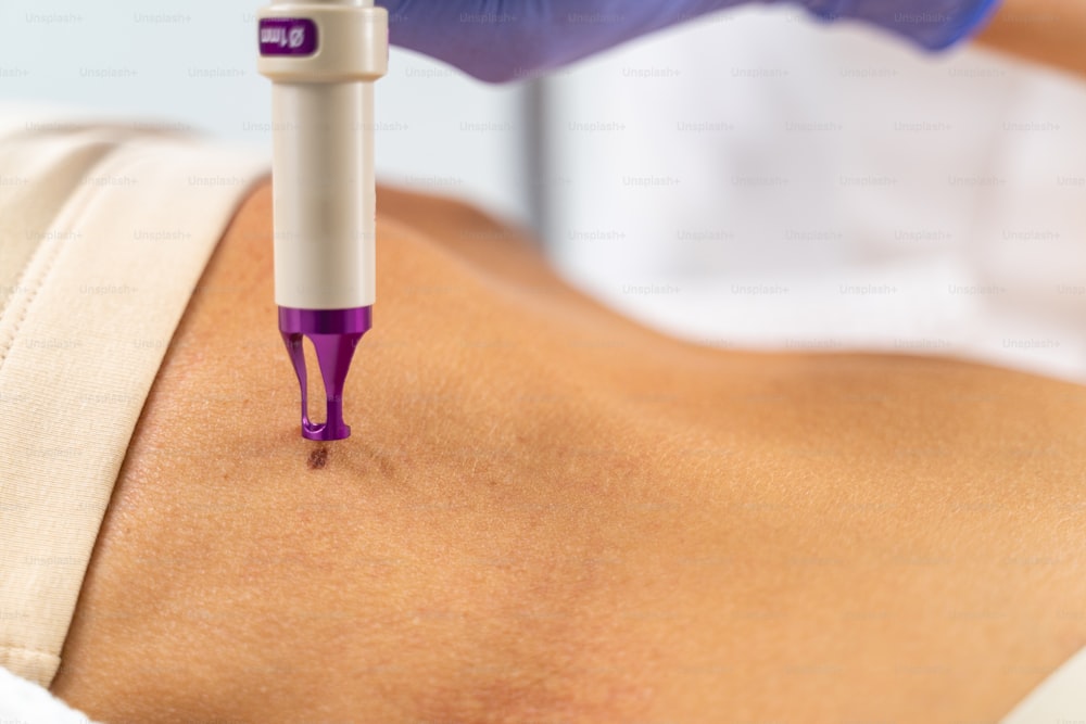 Photo recadrée d’une dermatologue dirigeant un faisceau laser vers le naevus sur la peau de sa patiente