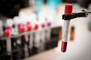중국 우한에서 COVID-19 테스트 및 새로운 코로나 바이러스 감염 진단을위한 혈액 검사의 실험실 샘플 (신종 코로나 바이러스 질병 2019). 전염병 전염성 개념