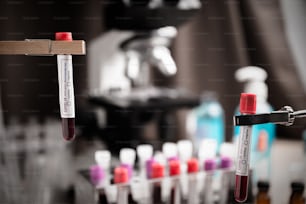 Test COVID-19 e campione di laboratorio di analisi del sangue per la diagnosi di nuova infezione da virus Corona (nuova malattia da virus corona 2019) da Wuhan, Cina. Concetto infettivo pandemico