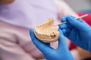 Person drawing attention to a black spot of tooth decay on a plaster jaw mold with dental probe