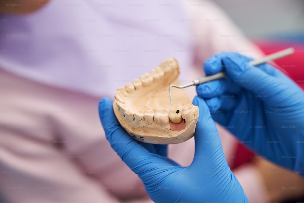 歯科用プローブで石膏顎型に見られる虫歯の黒い斑点に注意を向ける人