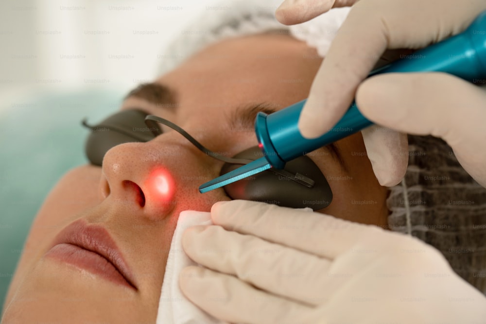 Cliente da mulher durante a remoção da toupeira a laser em uma clínica de estética médica