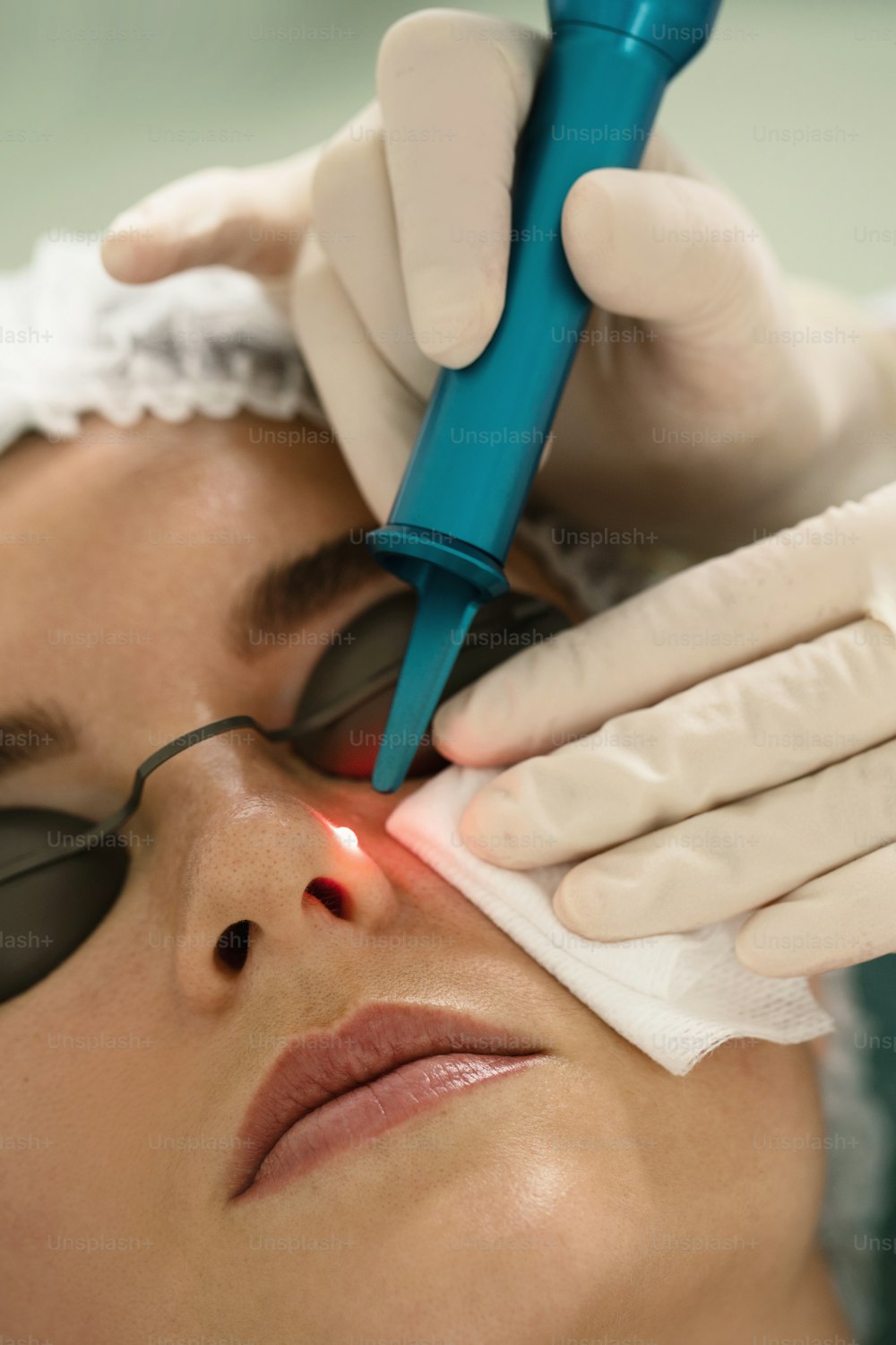 Woman client during laser mole removal in a medical aesthetic clinic