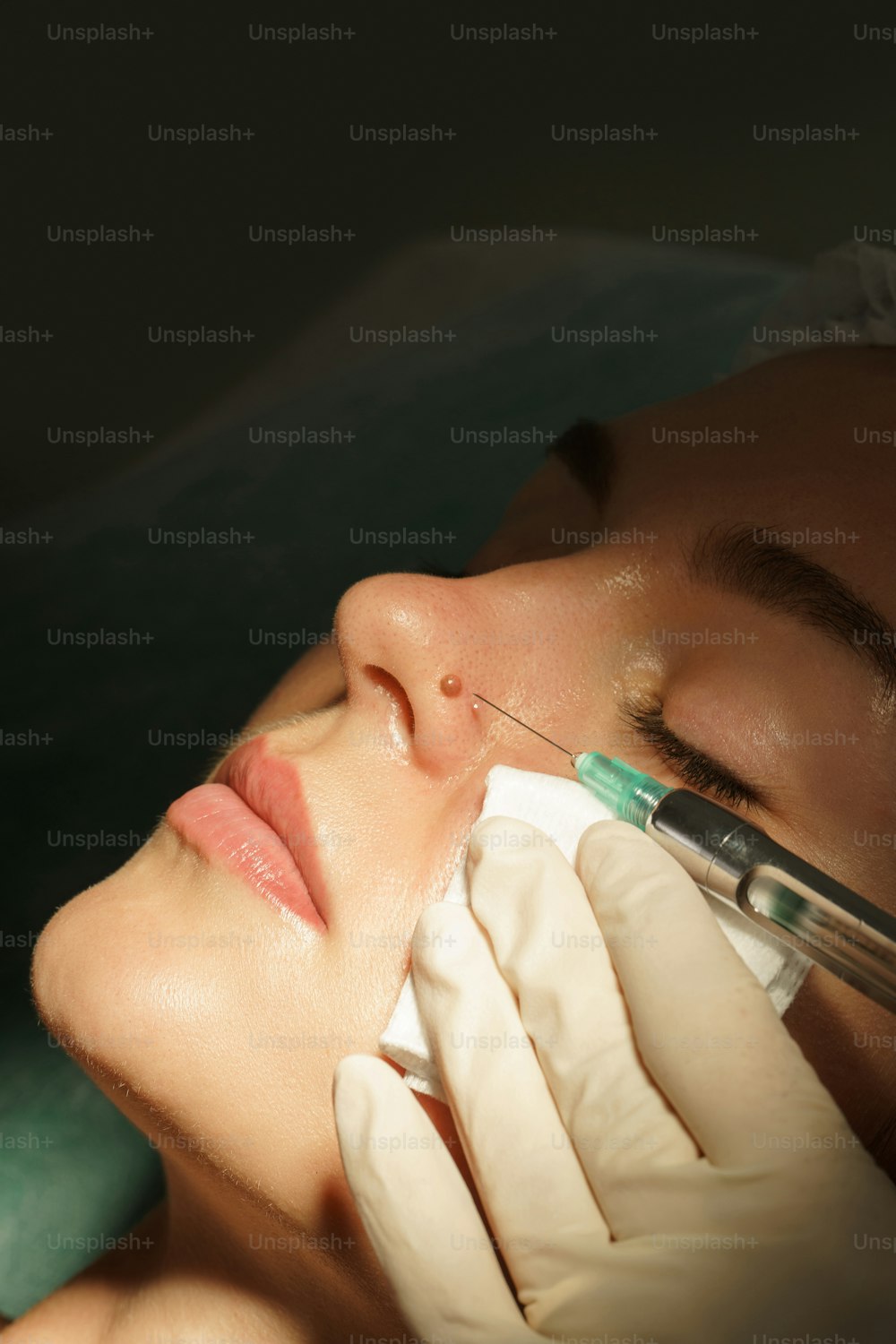 Mulher cliente recebendo injeção de anestésico local antes do tratamento de remoção da toupeira em uma clínica de estética médica