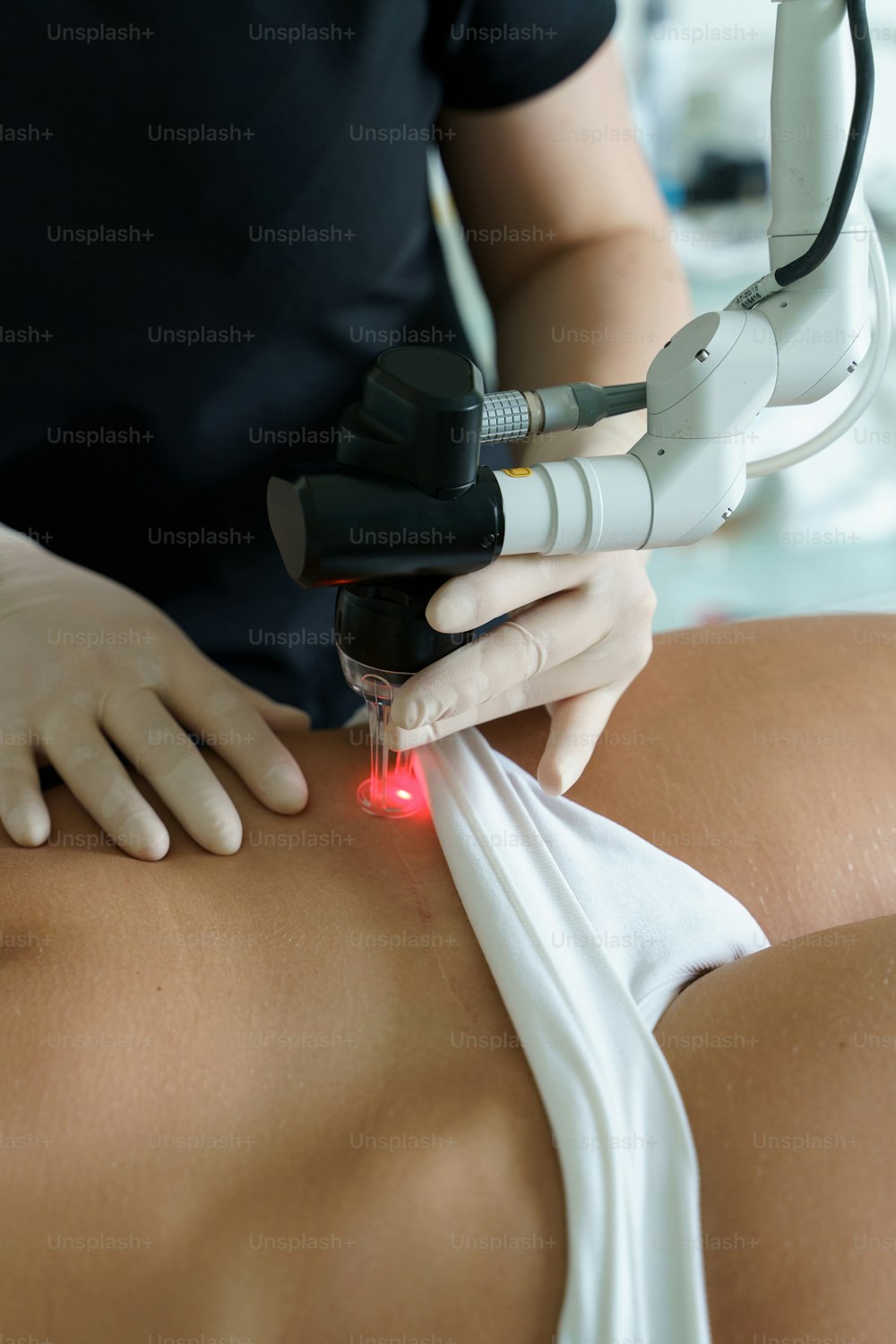 Laser treatment and scar removal after C-section surgery in a medical aesthetic clinic