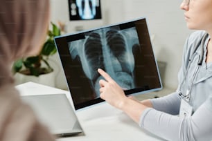 Mano del giovane medico che indica l'immagine a raggi X dei polmoni durante la consultazione e la spiegazione dei risultati della visita medica