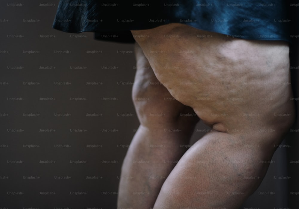 Uma mulher gorda com celulite nas pernas, cortada.
