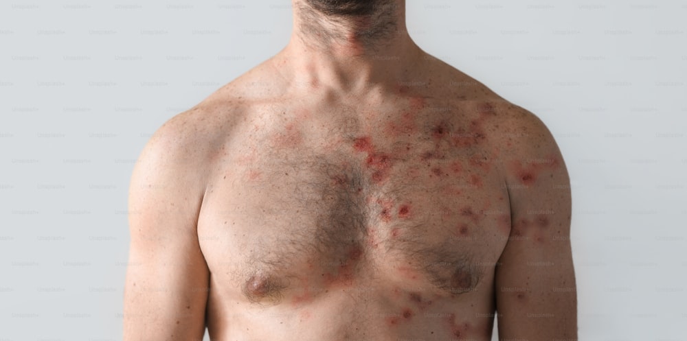 Un pecho masculino afectado por una erupción con ampollas debido a la viruela del mono u otra infección viral sobre fondo blanco