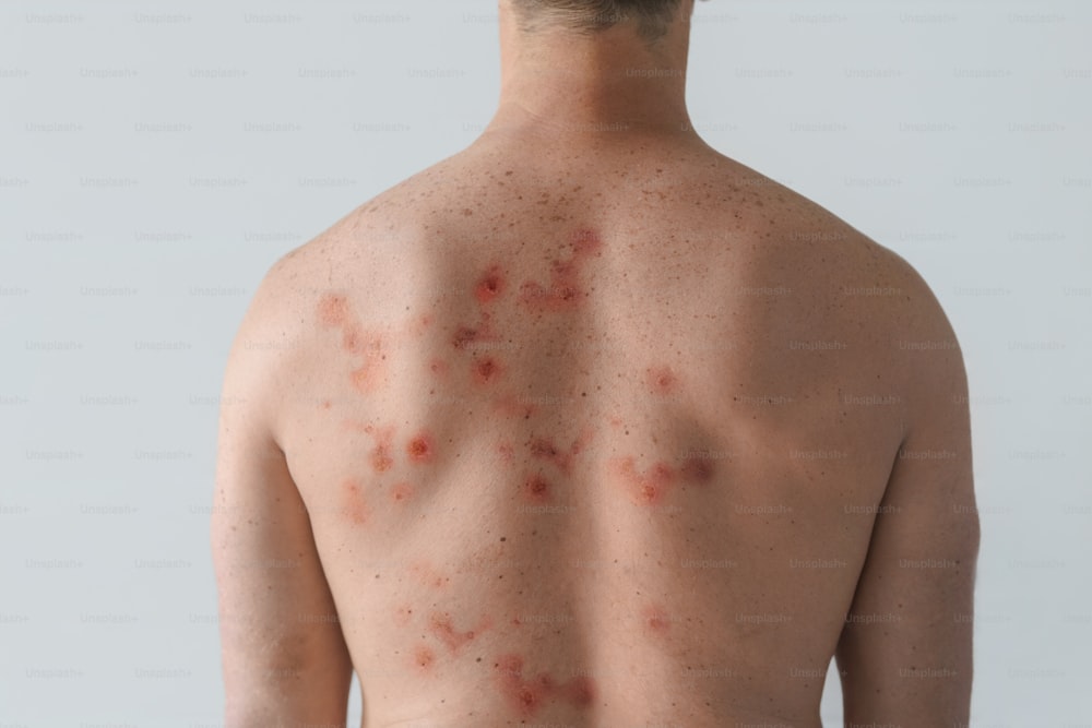 白い背景にサル痘やその他のウイルス感染による水疱性発疹の影響を受けた男性の背中