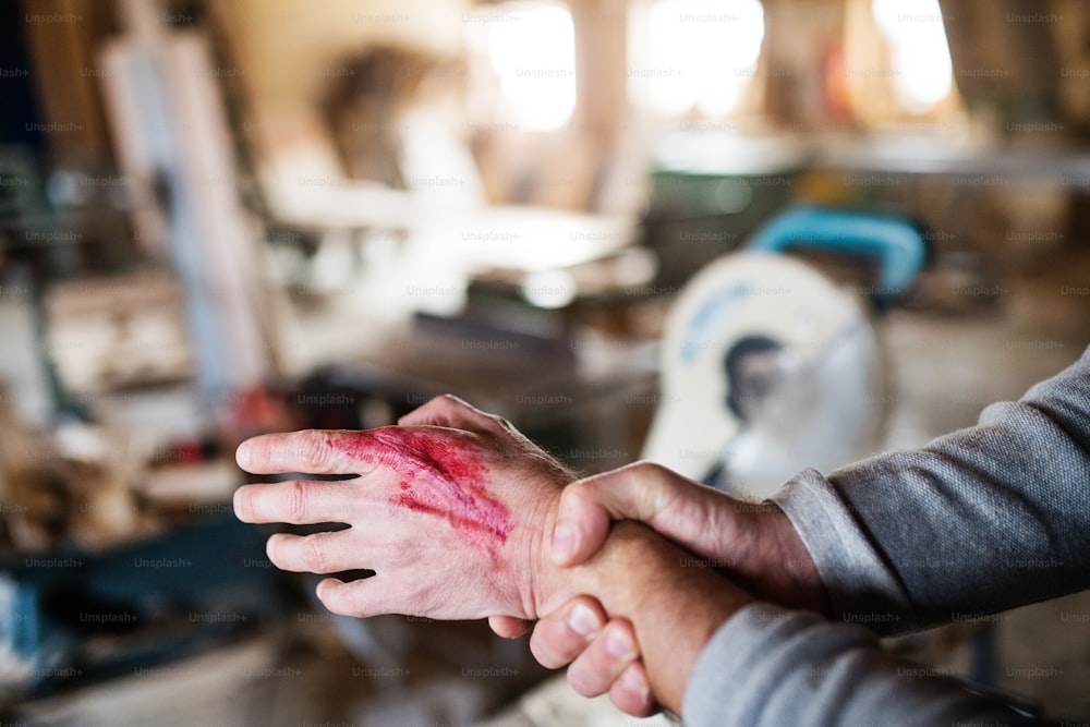 Um trabalhador na oficina de carpintaria, com uma mão ferida. Acidente de trabalho.