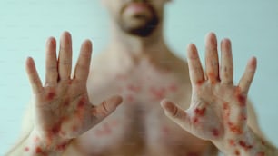 a Mains masculines affectées par une éruption cutanée vésiculeuse à cause de la variole du singe ou d’une autre infection virale sur fond vert