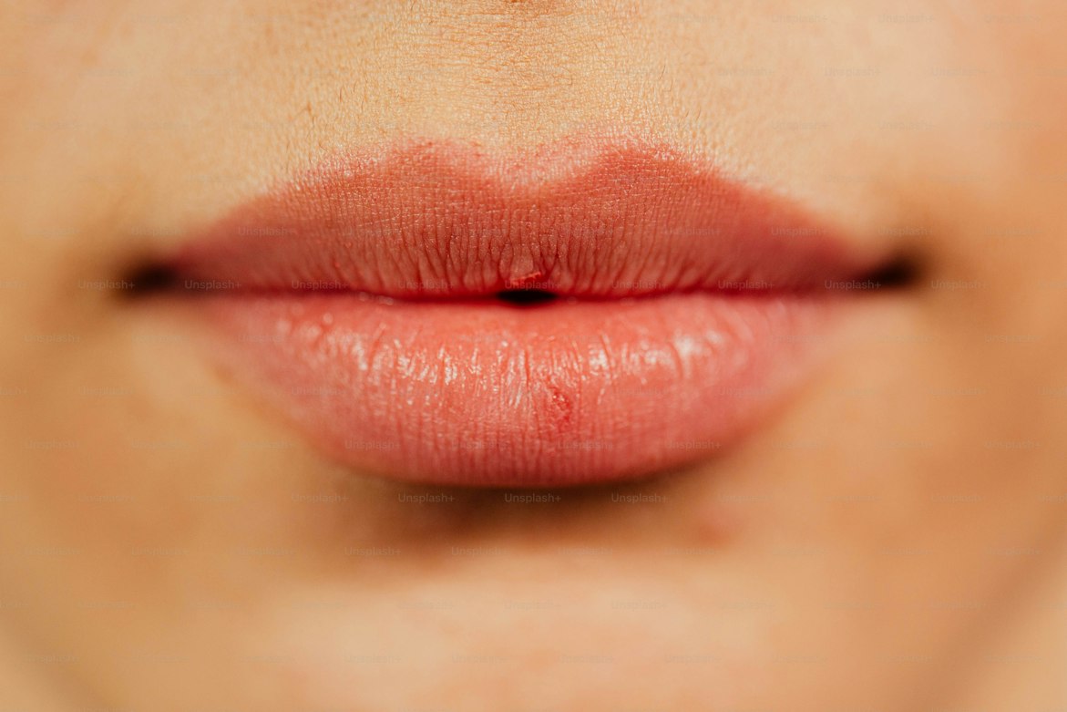 Diseño de Labios con ácido hialurónico