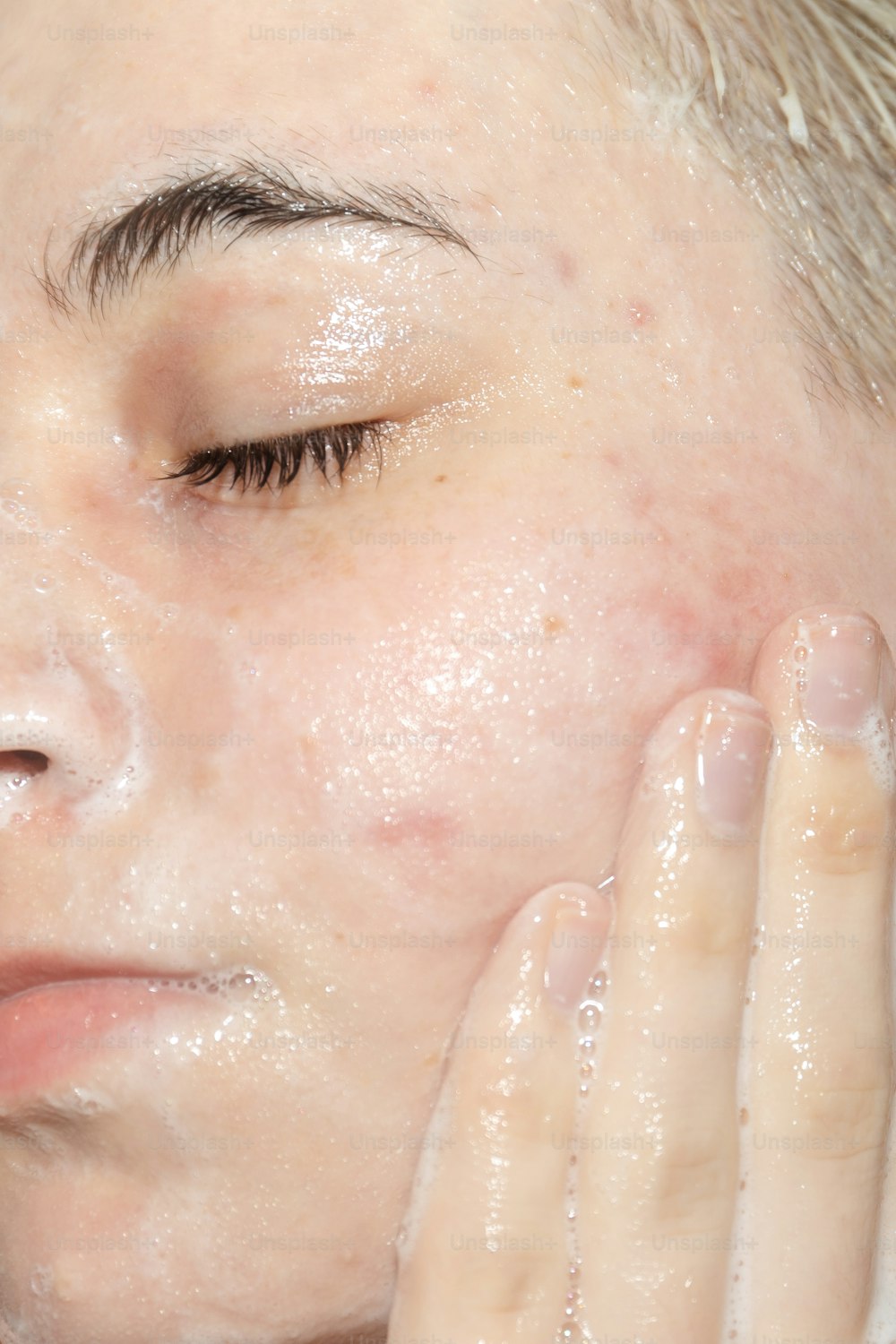 uma mulher com acne no rosto