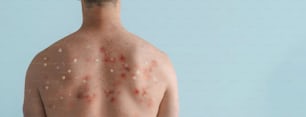 A male back affected by blistering rash because of monkeypox or other viral infection on white background