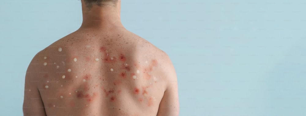 Una espalda masculina afectada por una erupción con ampollas debido a la viruela del simio u otra infección viral sobre fondo blanco