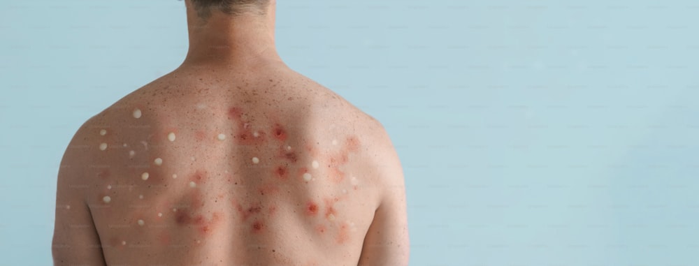 A male back affected by blistering rash because of monkeypox or other viral infection on white background