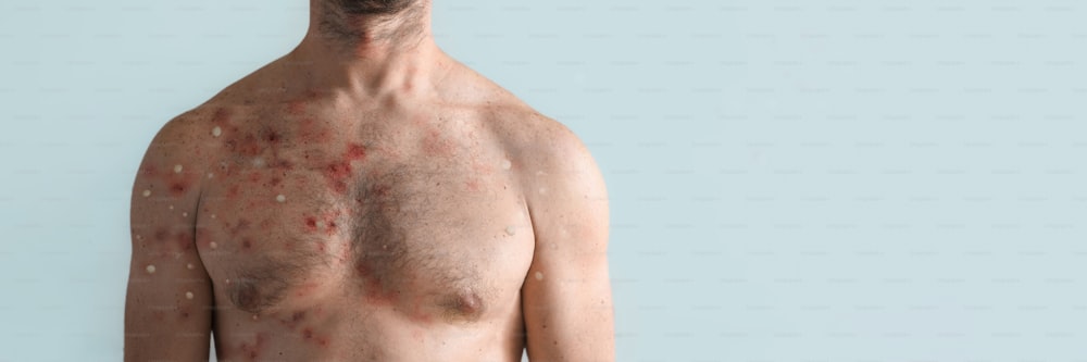 白い背景にサル痘または他のウイルス感染のために水疱性発疹の影響を受けた男性の胸