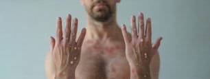 A male hands affected by blistering rash because of monkeypox or other viral infection on white background