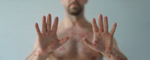 흰 배경에 원숭이두창 또는 기타 바이러스 감염으로 인해 물집이 생기는 발진의 영향을 받는 남성의 손