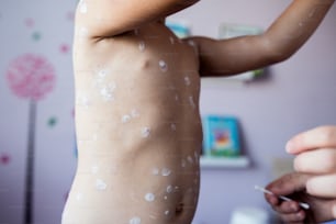 Kleines zweijähriges Mädchen zu Hause, das an Windpocken erkrankt ist, weiße antiseptische Creme, die von ihrer Mutter auf den Hautausschlag aufgetragen wurde
