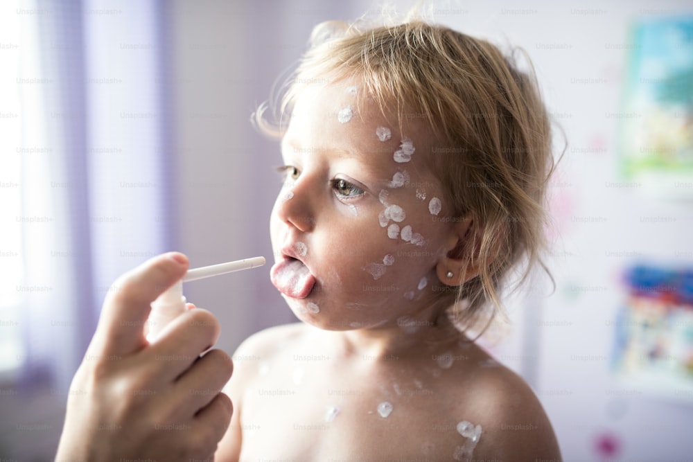 Menina de dois anos de idade em casa doente com varicela, creme antisséptico branco aplicado à erupção cutânea. Mãe irreconhecível dando spray médico a ela.