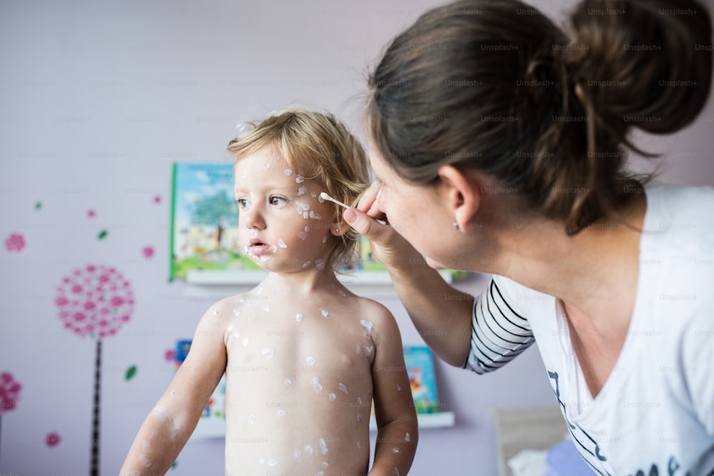 Menina de dois anos em casa doente com varicela, creme antisséptico branco aplicado por sua mãe à erupção cutânea.