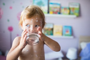 Piccola bambina di due anni a casa malata di varicella, crema antisettica bianca applicata all'eruzione cutanea. Tenendo in mano un bicchiere, acqua potabile.