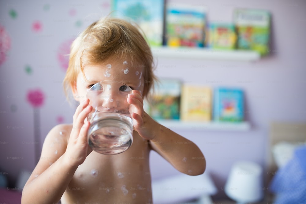 Little two year old girl at home sick with chickenpox, white antiseptic cream applied to the rash. Holding a glass, drinking water.