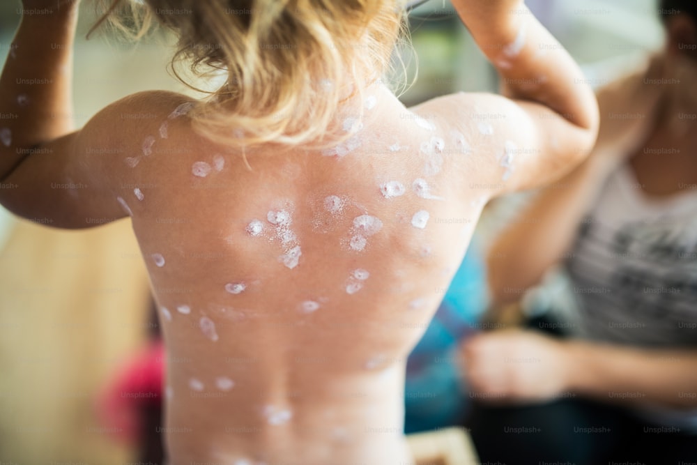 水痘にかかっている自宅で小さな2歳の女の子の背中。発疹に塗られた白い消毒クリーム。背面図。