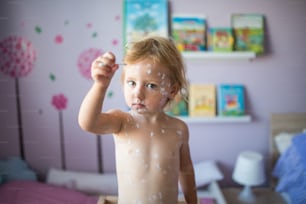 Kleines zweijähriges Mädchen zu Hause, das an Windpocken erkrankt ist und Wattestäbchen hält. Weiße antiseptische Creme, die auf den Hautausschlag aufgetragen wird.