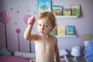 Little two year old girl at home sick with chickenpox, holding cotton bud. White antiseptic cream applied to the rash.