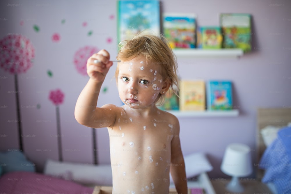 Menina de dois anos em casa doente com varicela, segurando cotonete. Creme antisséptico branco aplicado à erupção cutânea.