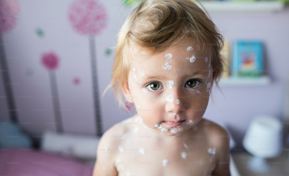 Piccola bambina di due anni a casa malata di varicella, crema antisettica bianca applicata all'eruzione cutanea