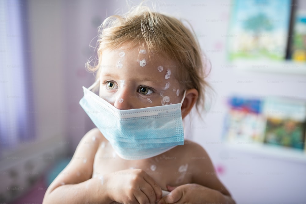 Kleines zweijähriges Mädchen zu Hause, das an Windpocken erkrankt ist, weiße antiseptische Creme, die auf den Hautausschlag aufgetragen wird