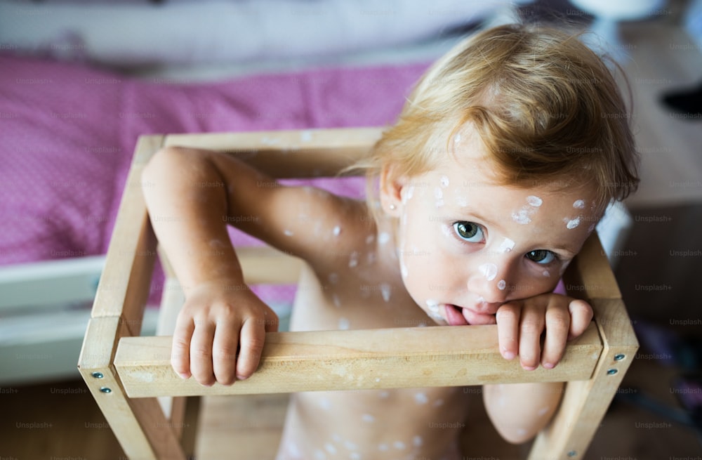 Niña de dos años en casa enferma de varicela, sentada en una silla de madera. Crema antiséptica blanca aplicada a la erupción.