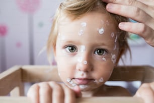 Faccia della piccola bambina di due anni a casa malata di varicella, crema antisettica bianca applicata all'eruzione cutanea