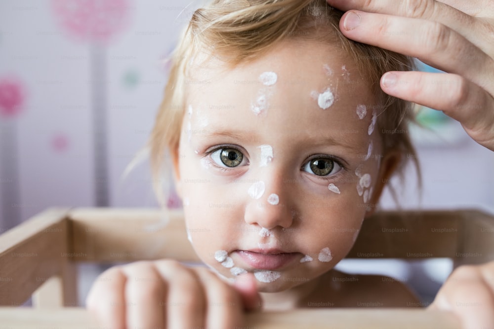 Face of little two year old girl at home sick with chickenpox, white antiseptic cream applied to the rash