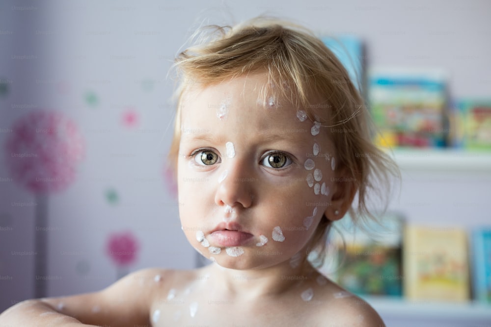 Little two year old girl at home sick with chickenpox, white antiseptic cream applied to the rash