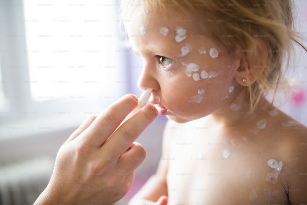 Piccola bambina di due anni a casa malata di varicella, crema antisettica bianca applicata all'eruzione cutanea. Madre irriconoscibile che le dà spray medico.