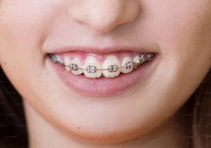 歯にブレースを付けた10代の少女が歯科医で治療を受けています