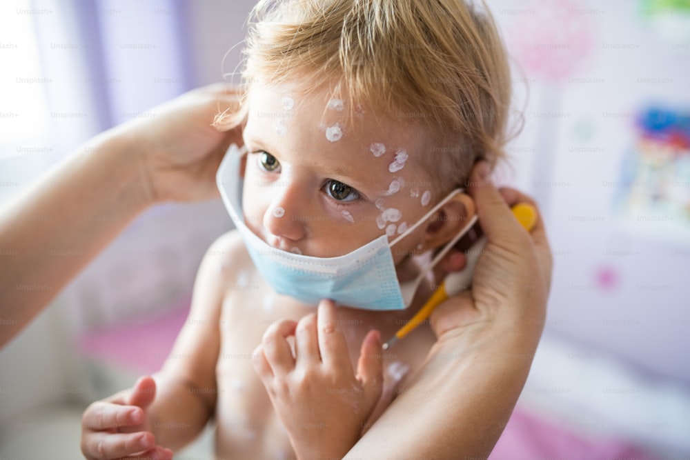 Kleines zweijähriges Mädchen zu Hause, das an Windpocken erkrankt ist, weiße antiseptische Creme, die auf den Hautausschlag aufgetragen wird. Unkenntliche Mutter, die ihre Schutzmaske gibt.